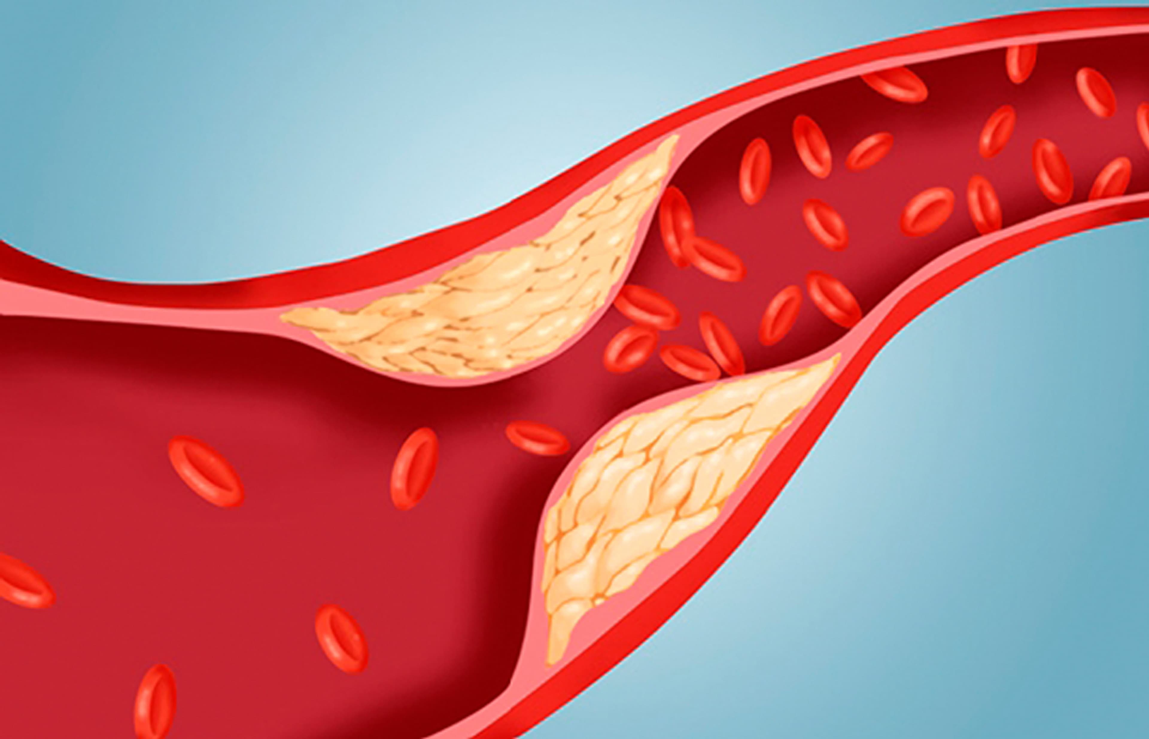 Hypertension Image